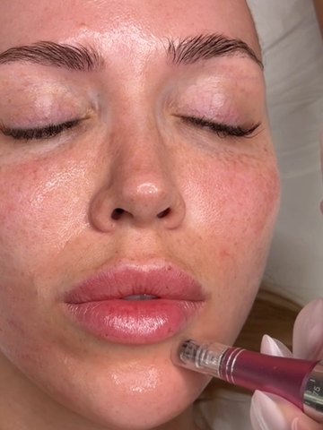 Soin de microneedling